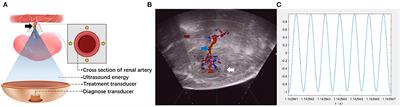 Optimal Strategy for HIFU-Based Renal Sympathetic Denervation in Canines